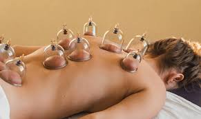Cupping Therapy